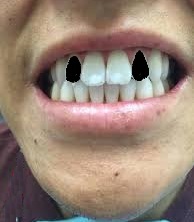 Zähne